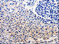 The image on the left is immunohistochemistry of paraffin-embedded Human liver cancer tissue using CSB-PA153558(CDC20 Antibody) at dilution 1/25, on the right is treated with fusion protein. (Original magnification: ×200)