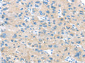 The image on the left is immunohistochemistry of paraffin-embedded Human liver cancer tissue using CSB-PA153577(IGFBP3 Antibody) at dilution 1/45, on the right is treated with synthetic peptide. (Original magnification: ×200)