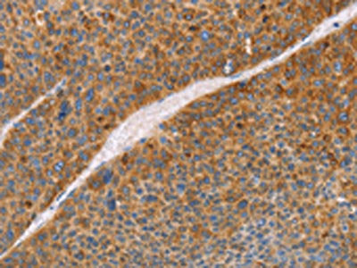The image on the left is immunohistochemistry of paraffin-embedded Human liver cancer tissue using CSB-PA153859(FGL1 Antibody) at dilution 1/50, on the right is treated with fusion protein. (Original magnification: ×200)