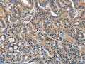 The image on the left is immunohistochemistry of paraffin-embedded Human thyroid cancer tissue using CSB-PA153980(HSD3B1 Antibody) at dilution 1/40, on the right is treated with fusion protein. (Original magnification: ×200)