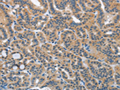 The image on the left is immunohistochemistry of paraffin-embedded Human thyroid cancer tissue using CSB-PA153980(HSD3B1 Antibody) at dilution 1/40, on the right is treated with fusion protein. (Original magnification: ×200)