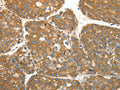 The image on the left is immunohistochemistry of paraffin-embedded Human liver cancer tissue using CSB-PA153990(RPLP0 Antibody) at dilution 1/40, on the right is treated with fusion protein. (Original magnification: ×200)