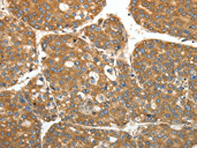 The image on the left is immunohistochemistry of paraffin-embedded Human liver cancer tissue using CSB-PA153990(RPLP0 Antibody) at dilution 1/40, on the right is treated with fusion protein. (Original magnification: ×200)