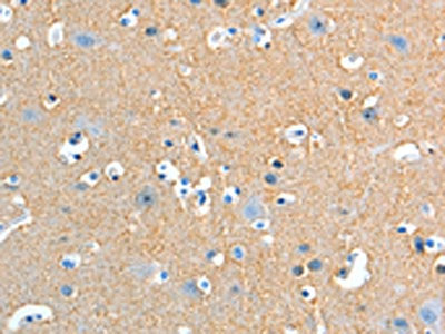 The image on the left is immunohistochemistry of paraffin-embedded Human brain tissue using CSB-PA154092(ADD2 Antibody) at dilution 1/20, on the right is treated with fusion protein. (Original magnification: ×200)