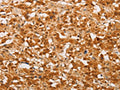 The image on the left is immunohistochemistry of paraffin-embedded Human thyroid cancer tissue using CSB-PA154285(THOC7 Antibody) at dilution 1/30, on the right is treated with fusion protein. (Original magnification: ×200)
