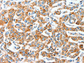 The image on the left is immunohistochemistry of paraffin-embedded Human breast cancer tissue using CSB-PA154373(AFAP1 Antibody) at dilution 1/20, on the right is treated with fusion protein. (Original magnification: X200)