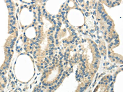 The image on the left is immunohistochemistry of paraffin-embedded Human thyroid cancer tissue using CSB-PA154465(WNT6 Antibody) at dilution 1/35, on the right is treated with synthetic peptide. (Original magnification: ×200)