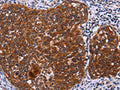 The image on the left is immunohistochemistry of paraffin-embedded Human cervical cancer tissue using CSB-PA155084(USP2 Antibody) at dilution 1/40, on the right is treated with fusion protein. (Original magnification: ×200)