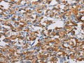 The image on the left is immunohistochemistry of paraffin-embedded Human thyroid cancer tissue using CSB-PA155145(TSPEAR Antibody) at dilution 1/50, on the right is treated with fusion protein. (Original magnification: ×200)