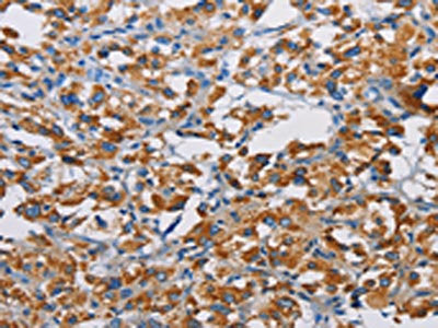 The image on the left is immunohistochemistry of paraffin-embedded Human thyroid cancer tissue using CSB-PA155145(TSPEAR Antibody) at dilution 1/50, on the right is treated with fusion protein. (Original magnification: ×200)