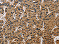 The image on the left is immunohistochemistry of paraffin-embedded Human liver cancer tissue using CSB-PA155390(IL19 Antibody) at dilution 1/40, on the right is treated with synthetic peptide. (Original magnification: ×200)