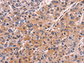 The image on the left is immunohistochemistry of paraffin-embedded Human liver cancer tissue using CSB-PA155590(COL20A1 Antibody) at dilution 1/30, on the right is treated with fusion protein. (Original magnification: ×200)