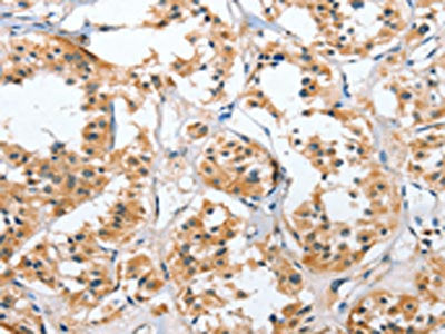 The image on the left is immunohistochemistry of paraffin-embedded Human thyroid cancer tissue using CSB-PA156347(UGCG Antibody) at dilution 1/50, on the right is treated with fusion protein. (Original magnification: ×200)