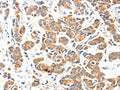 The image on the left is immunohistochemistry of paraffin-embedded Human breast cancer tissue using CSB-PA156662(AEBP2 Antibody) at dilution 1/25, on the right is treated with fusion protein. (Original magnification: ×200)