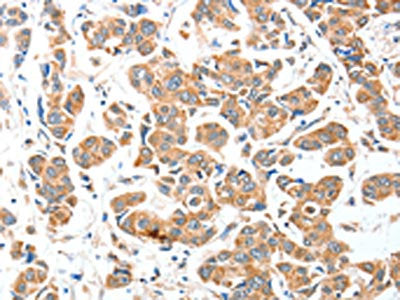 The image on the left is immunohistochemistry of paraffin-embedded Human breast cancer tissue using CSB-PA156662(AEBP2 Antibody) at dilution 1/25, on the right is treated with fusion protein. (Original magnification: ×200)