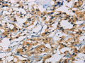 The image on the left is immunohistochemistry of paraffin-embedded Human thyroid cancer tissue using CSB-PA156748(CSNK1E Antibody) at dilution 1/30, on the right is treated with fusion protein. (Original magnification: ×200)