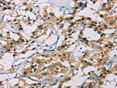 The image on the left is immunohistochemistry of paraffin-embedded Human thyroid cancer tissue using CSB-PA156748(CSNK1E Antibody) at dilution 1/30, on the right is treated with fusion protein. (Original magnification: ×200)