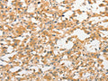 The image on the left is immunohistochemistry of paraffin-embedded Human thyroid cancer tissue using CSB-PA157170(TLR3 Antibody) at dilution 1/40, on the right is treated with fusion protein. (Original magnification: ×200)