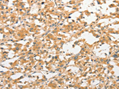 The image on the left is immunohistochemistry of paraffin-embedded Human thyroid cancer tissue using CSB-PA157170(TLR3 Antibody) at dilution 1/40, on the right is treated with fusion protein. (Original magnification: ×200)