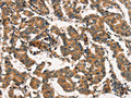The image on the left is immunohistochemistry of paraffin-embedded Human breast cancer tissue using CSB-PA157358(ARL6IP1 Antibody) at dilution 1/20, on the right is treated with fusion protein. (Original magnification: ×200)