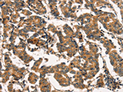 The image on the left is immunohistochemistry of paraffin-embedded Human breast cancer tissue using CSB-PA157358(ARL6IP1 Antibody) at dilution 1/20, on the right is treated with fusion protein. (Original magnification: ×200)