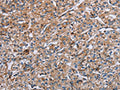 The image on the left is immunohistochemistry of paraffin-embedded Human prostate cancer tissue using CSB-PA157482(PLG Antibody) at dilution 1/40, on the right is treated with synthetic peptide. (Original magnification: ×200)