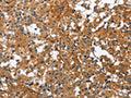 The image on the left is immunohistochemistry of paraffin-embedded Human thyroid cancer tissue using CSB-PA157570(BGN Antibody) at dilution 1/50, on the right is treated with fusion protein. (Original magnification: ×200)