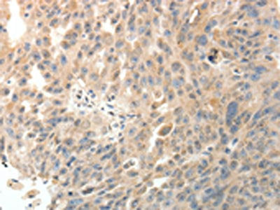 The image on the left is immunohistochemistry of paraffin-embedded Human ovarian cancer tissue using CSB-PA157934(PTHLH Antibody) at dilution 1/20, on the right is treated with fusion protein. (Original magnification: ×200)