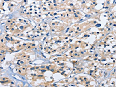 The image on the left is immunohistochemistry of paraffin-embedded Human thyroid cancer tissue using CSB-PA157953(DUSP19 Antibody) at dilution 1/30, on the right is treated with fusion protein. (Original magnification: ×200)