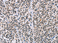 The image on the left is immunohistochemistry of paraffin-embedded Human esophagus cancer tissue using CSB-PA157994(ADNP Antibody) at dilution 1/50, on the right is treated with synthetic peptide. (Original magnification: ×200)