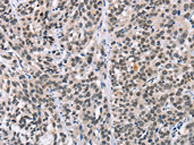 The image on the left is immunohistochemistry of paraffin-embedded Human esophagus cancer tissue using CSB-PA157994(ADNP Antibody) at dilution 1/50, on the right is treated with synthetic peptide. (Original magnification: ×200)