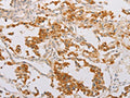 The image on the left is immunohistochemistry of paraffin-embedded Human thyroid cancer tissue using CSB-PA158011(STK40 Antibody) at dilution 1/40, on the right is treated with fusion protein. (Original magnification: ×200)
