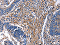The image on the left is immunohistochemistry of paraffin-embedded Human rectal cancer tissue using CSB-PA158258(CXCR5 Antibody) at dilution 1/25, on the right is treated with synthetic peptide. (Original magnification: ×200)