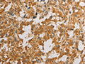 The image on the left is immunohistochemistry of paraffin-embedded Human thyroid cancer tissue using CSB-PA158452(ATG4D Antibody) at dilution 1/40, on the right is treated with fusion protein. (Original magnification: ×200)