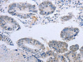The image on the left is immunohistochemistry of paraffin-embedded Human colon cancer tissue using CSB-PA158538(DOK5 Antibody) at dilution 1/20, on the right is treated with fusion protein. (Original magnification: ×200)