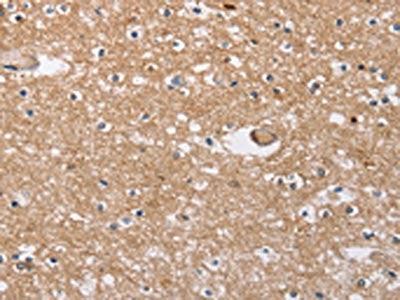 The image on the left is immunohistochemistry of paraffin-embedded Human brain tissue using CSB-PA158942(SOCS2 Antibody) at dilution 1/40, on the right is treated with fusion protein. (Original magnification: ×200)