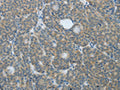 The image on the left is immunohistochemistry of paraffin-embedded Human thyroid cancer tissue using CSB-PA158988(TP63 Antibody) at dilution 1/20, on the right is treated with fusion protein. (Original magnification: ×200)