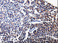 The image on the left is immunohistochemistry of paraffin-embedded Human tonsil tissue using CSB-PA159155(BIRC5 Antibody) at dilution 1/15, on the right is treated with fusion protein. (Original magnification: ×200)