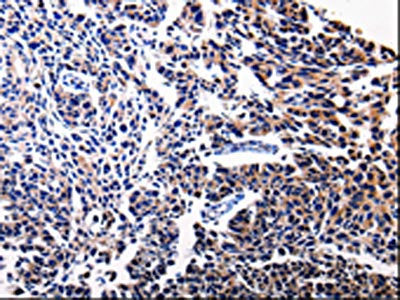 The image on the left is immunohistochemistry of paraffin-embedded Human tonsil tissue using CSB-PA159155(BIRC5 Antibody) at dilution 1/15, on the right is treated with fusion protein. (Original magnification: ×200)