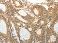 The image on the left is immunohistochemistry of paraffin-embedded Human colon cancer tissue using CSB-PA159695(ADAR Antibody) at dilution 1/25, on the right is treated with synthetic peptide. (Original magnification: ×200)
