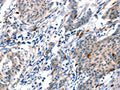 The image on the left is immunohistochemistry of paraffin-embedded Human gastic cancer tissue using CSB-PA160137(ADM Antibody) at dilution 1/20, on the right is treated with synthetic peptide. (Original magnification: ×200)