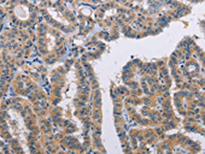 The image on the left is immunohistochemistry of paraffin-embedded Human thyroid cancer tissue using CSB-PA160291(TLR8 Antibody) at dilution 1/35, on the right is treated with fusion protein. (Original magnification: X200)