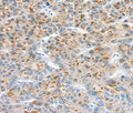 Immunohistochemical analysis of paraffin-embedded Human liver cancer tissue using at dilution 1/30.