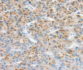 Immunohistochemical analysis of paraffin-embedded Human liver cancer tissue using at dilution 1/30.