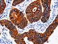 The image on the left is immunohistochemistry of paraffin-embedded Human colon cancer tissue using CSB-PA160649(KRT6A Antibody) at dilution 1/25, on the right is treated with fusion protein. (Original magnification: ×200)