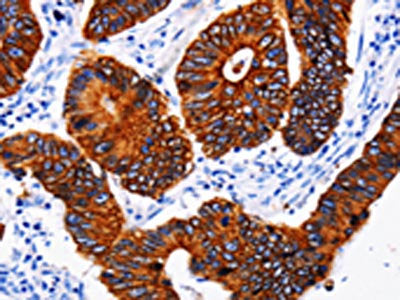 The image on the left is immunohistochemistry of paraffin-embedded Human colon cancer tissue using CSB-PA160649(KRT6A Antibody) at dilution 1/25, on the right is treated with fusion protein. (Original magnification: ×200)