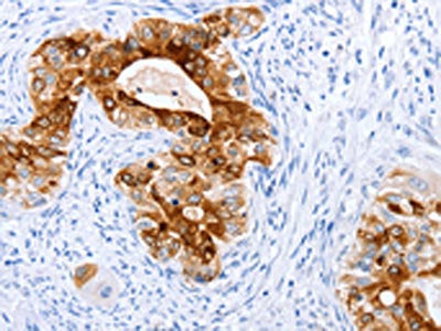 The image on the left is immunohistochemistry of paraffin-embedded Human cervical cancer tissue using CSB-PA160693(TFF1 Antibody) at dilution 1/20, on the right is treated with fusion protein. (Original magnification: ×200)