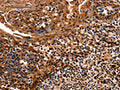 The image on the left is immunohistochemistry of paraffin-embedded Human tonsil tissue using CSB-PA160863(HSPD1 Antibody) at dilution 1/12, on the right is treated with fusion protein. (Original magnification: ×200)