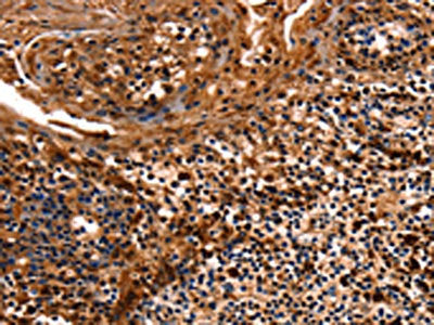 The image on the left is immunohistochemistry of paraffin-embedded Human tonsil tissue using CSB-PA160863(HSPD1 Antibody) at dilution 1/12, on the right is treated with fusion protein. (Original magnification: ×200)