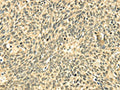 The image on the left is immunohistochemistry of paraffin-embedded Human lung cancer tissue using CSB-PA160915(ECE2 Antibody) at dilution 1/20, on the right is treated with fusion protein. (Original magnification: ×200)